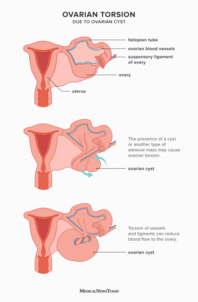 Ovarian Cyst  Symptoms, Risk Factors, Types & Treatment