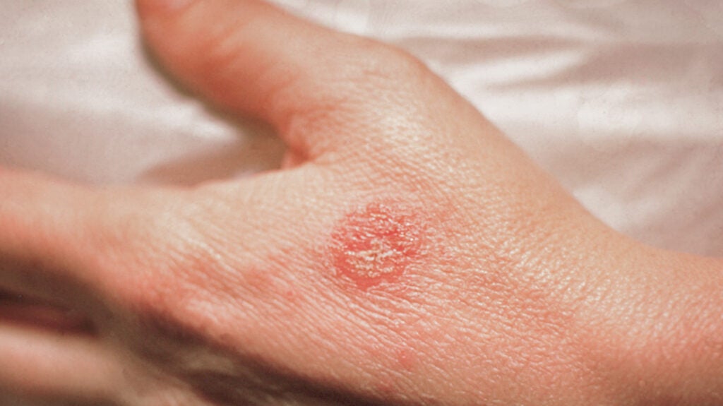 circle on the skin but not ringworm: Other causes