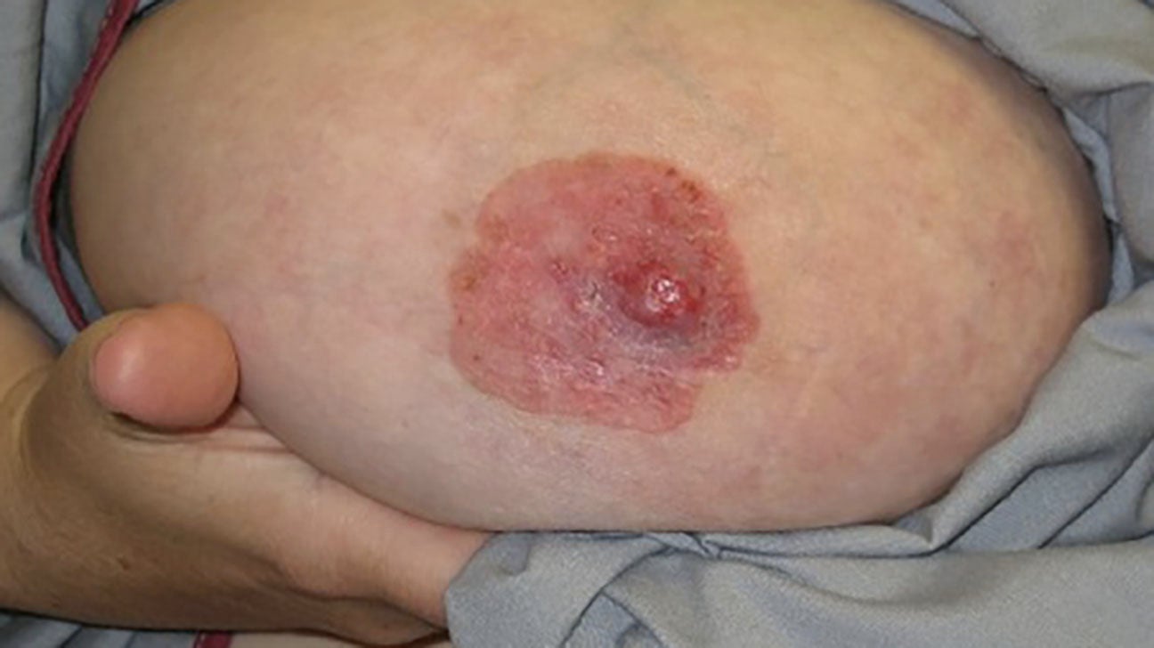 Psoriasis on Nipple and Areola: Pictures, Signs, Relief