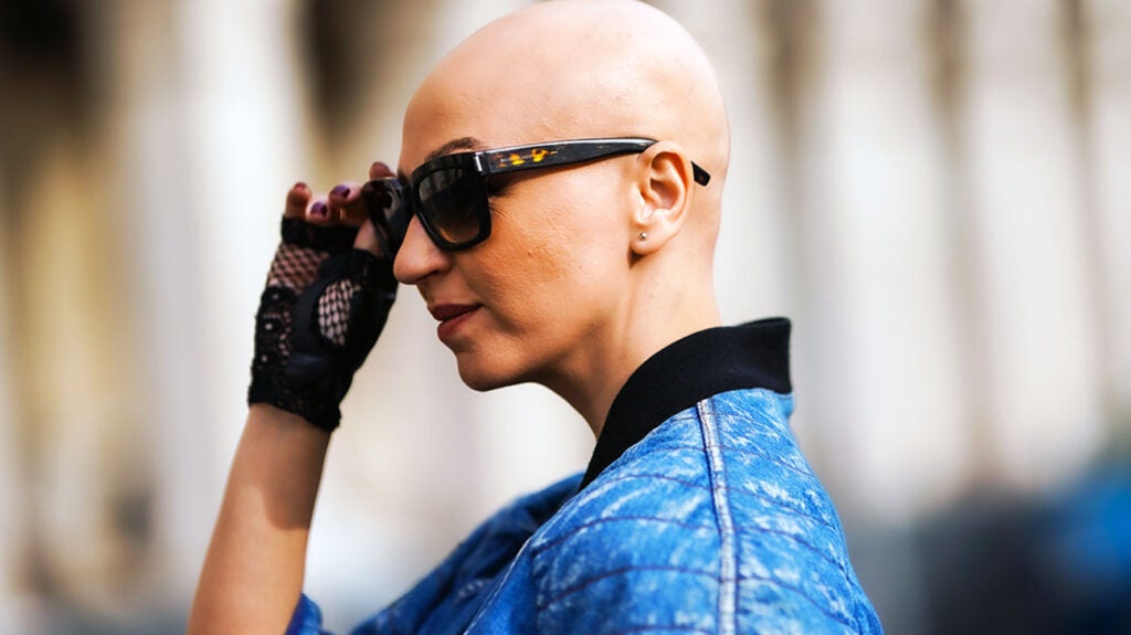 Alopecia areata Arthritis drug helps 1 in 3 people regrow hair