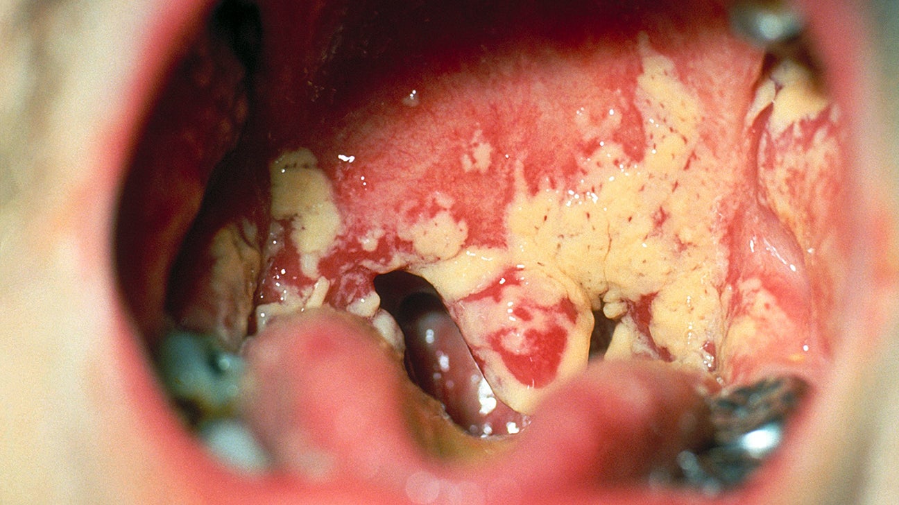 swollen tonsils with white spots and swollen glands