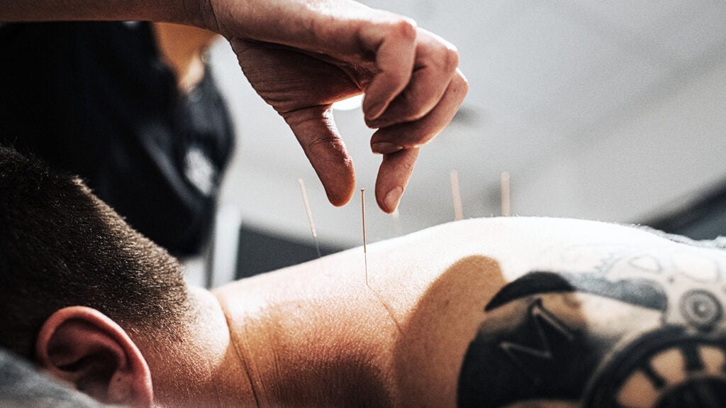 A, Traditional acupuncture: manual manipulation of an inserted needle