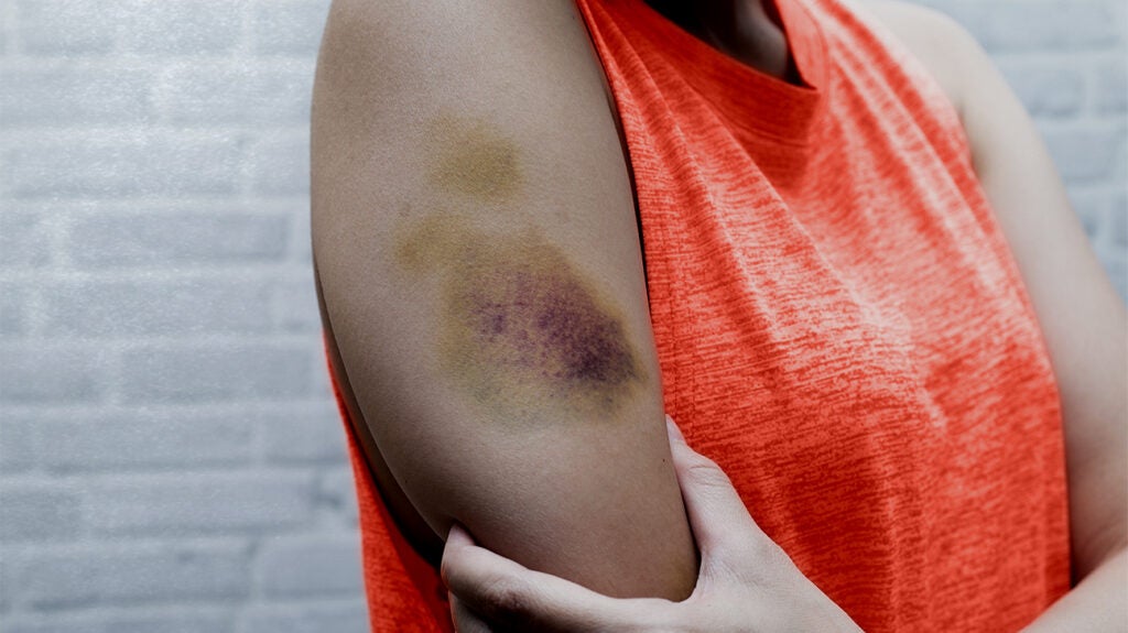 why-do-i-bruise-easily-8-possible-causes