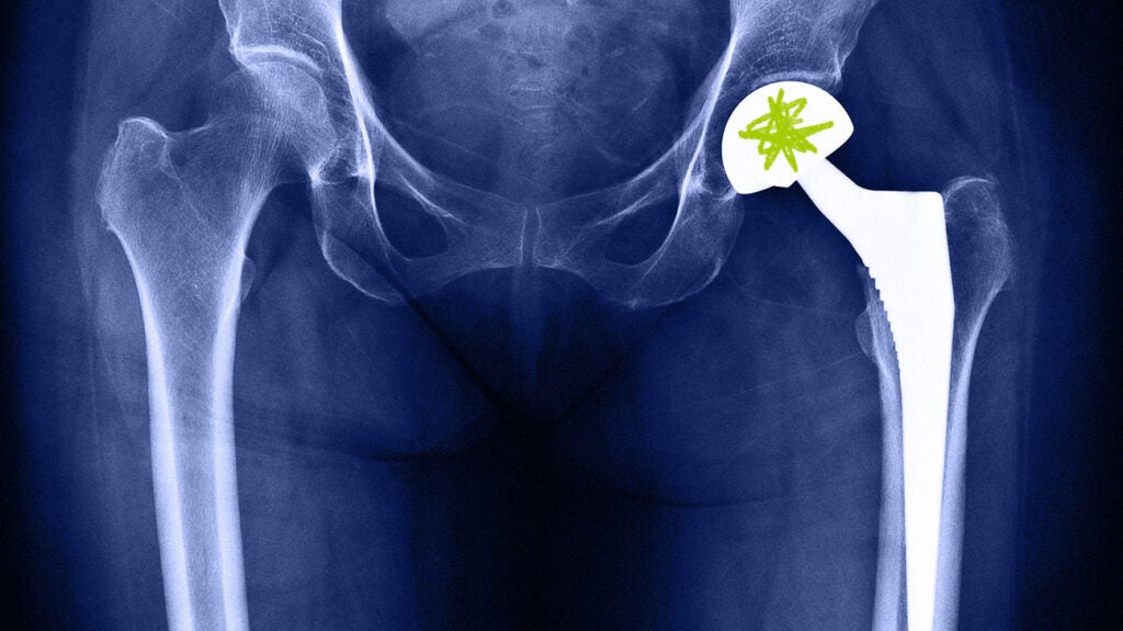 Think You Need a Hip Replacement? Here's What to Know
