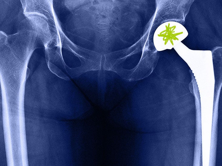 What is involved with Partial Hip Replacement Recovery?
