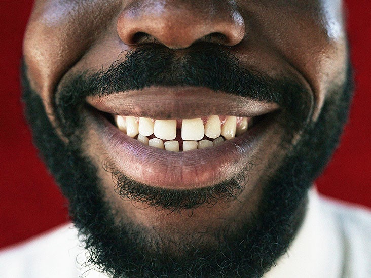 Do receding gums grow back? Treatments and prevention