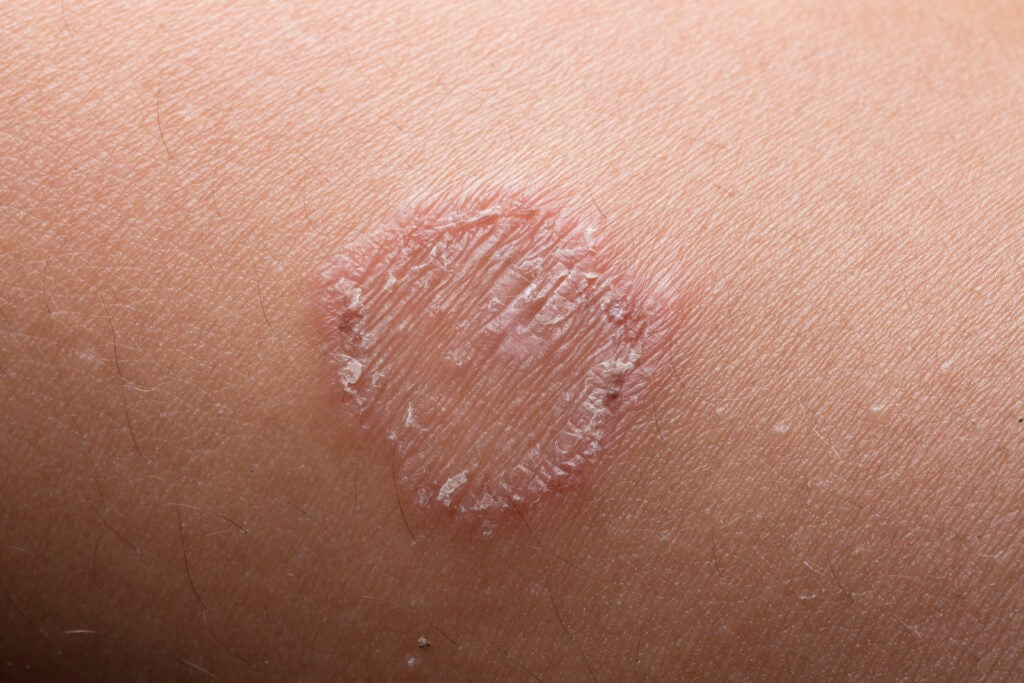 Ringworm: Treatment, symptoms, and pictures