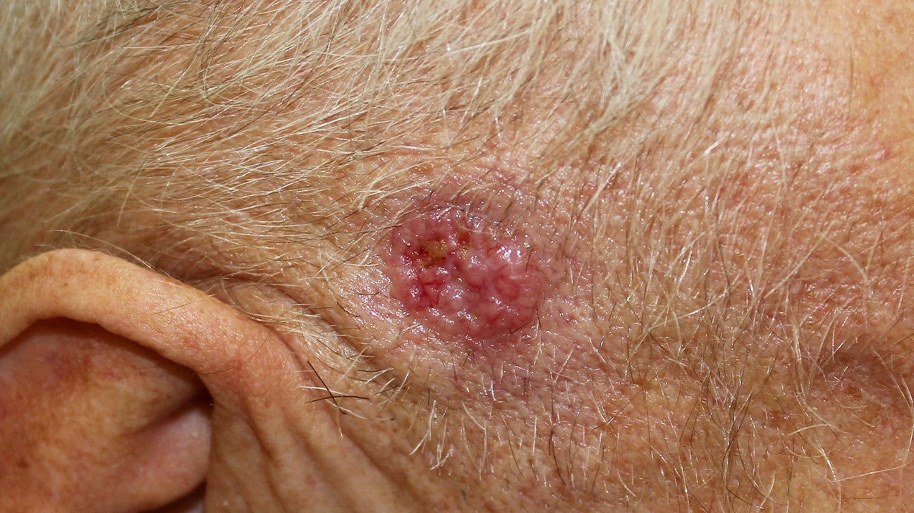 basal cell carcinoma vs squamous cell carcinoma