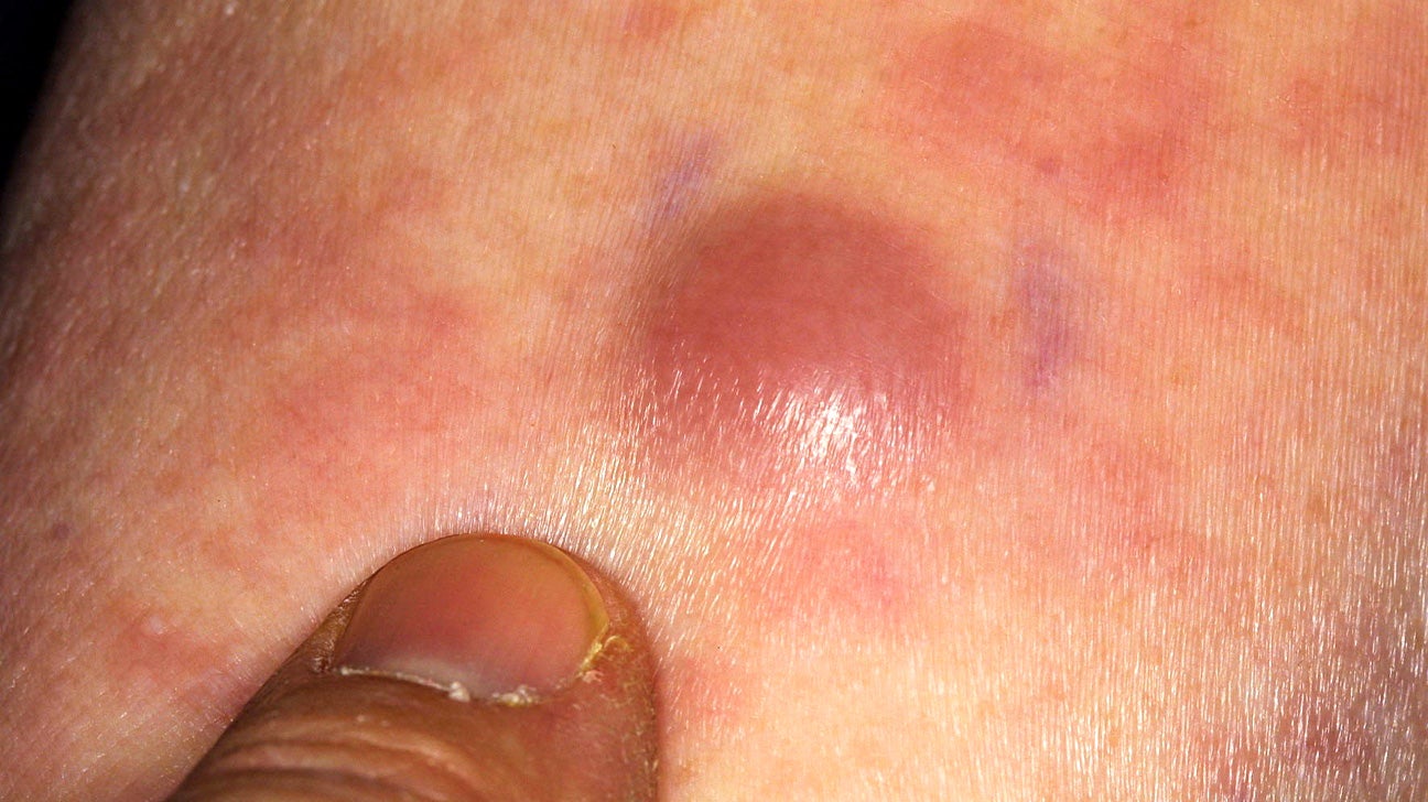 Acute myeloid leukemia (AML) rash Appearance and signs pic