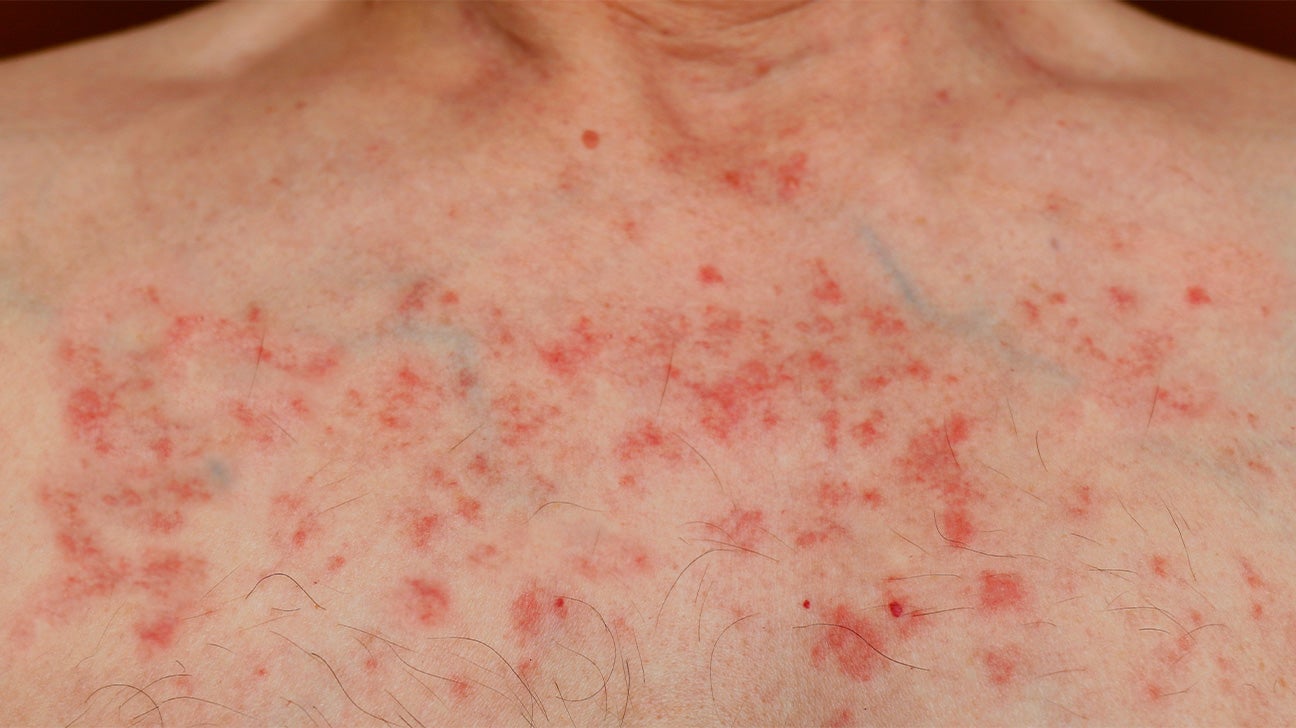 What Does a Breast Cancer Rash Look Like?