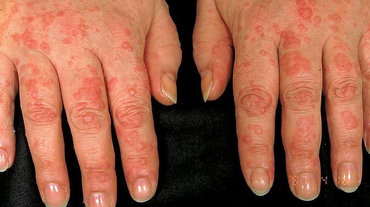 rashes on hands