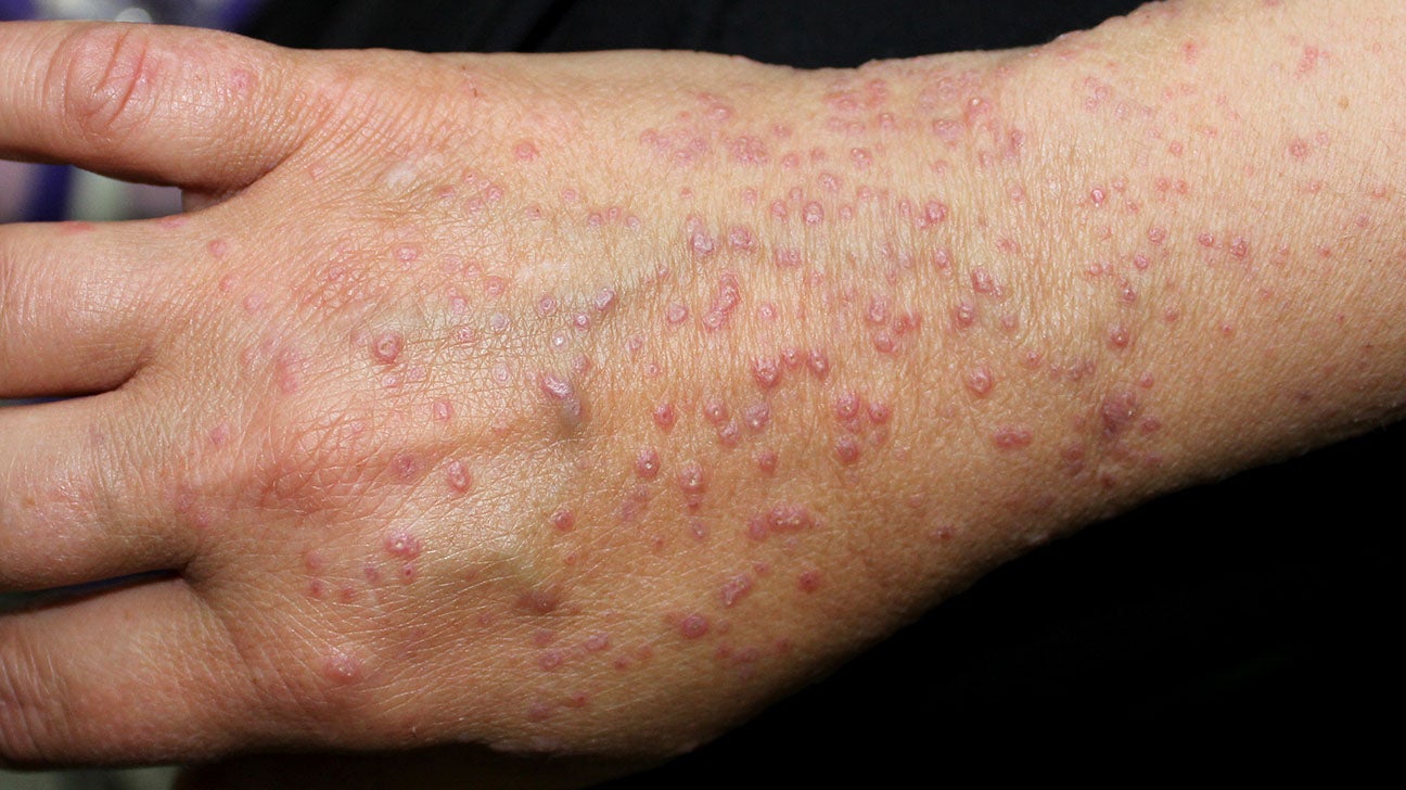 skin rashes on hands