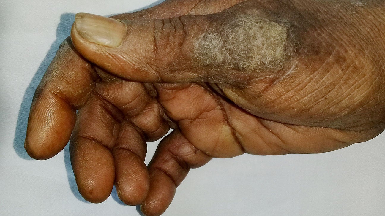 hives on hands