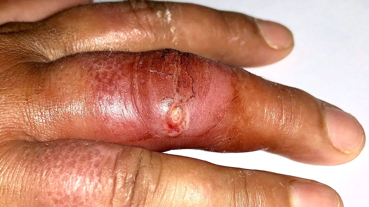 skin rashes on hands