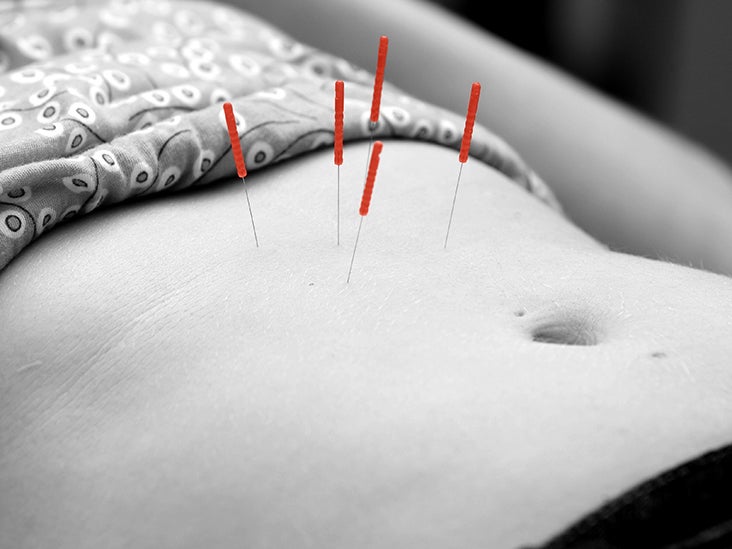 Acupuncture for GERD Research, alternatives, and FAQs