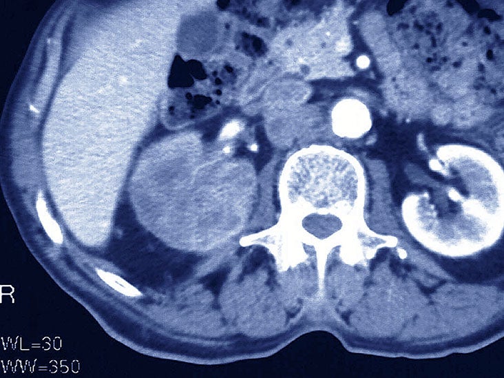 Chromophobe renal cell carcinoma: Signs, staging, and outlook