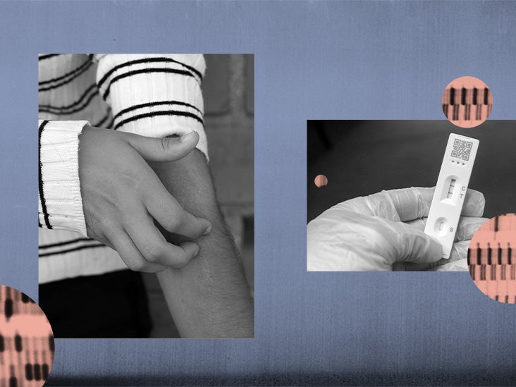 COVID19 and eczema Relationship, symptoms, and more