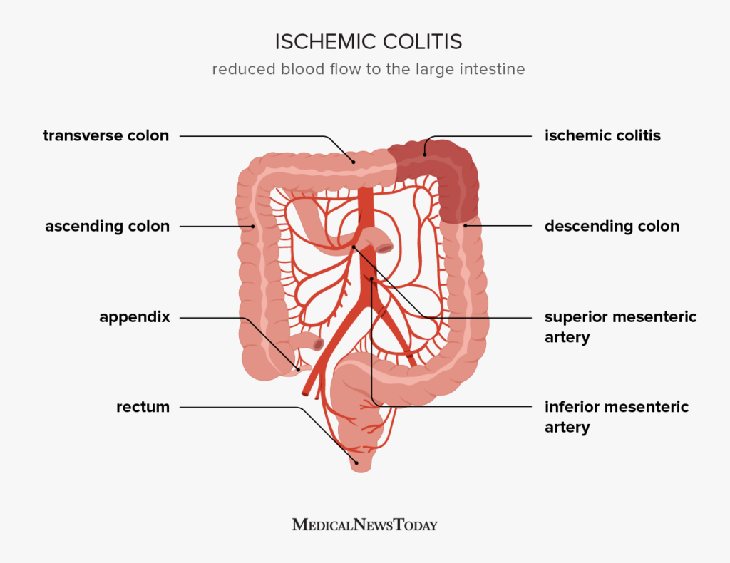 Ischemic colitis Causes, symptoms, and treatment