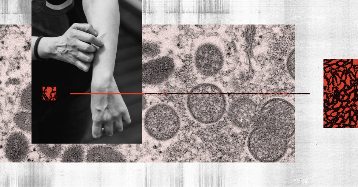 What does the monkeypox outbreak mean for people living with HIV?