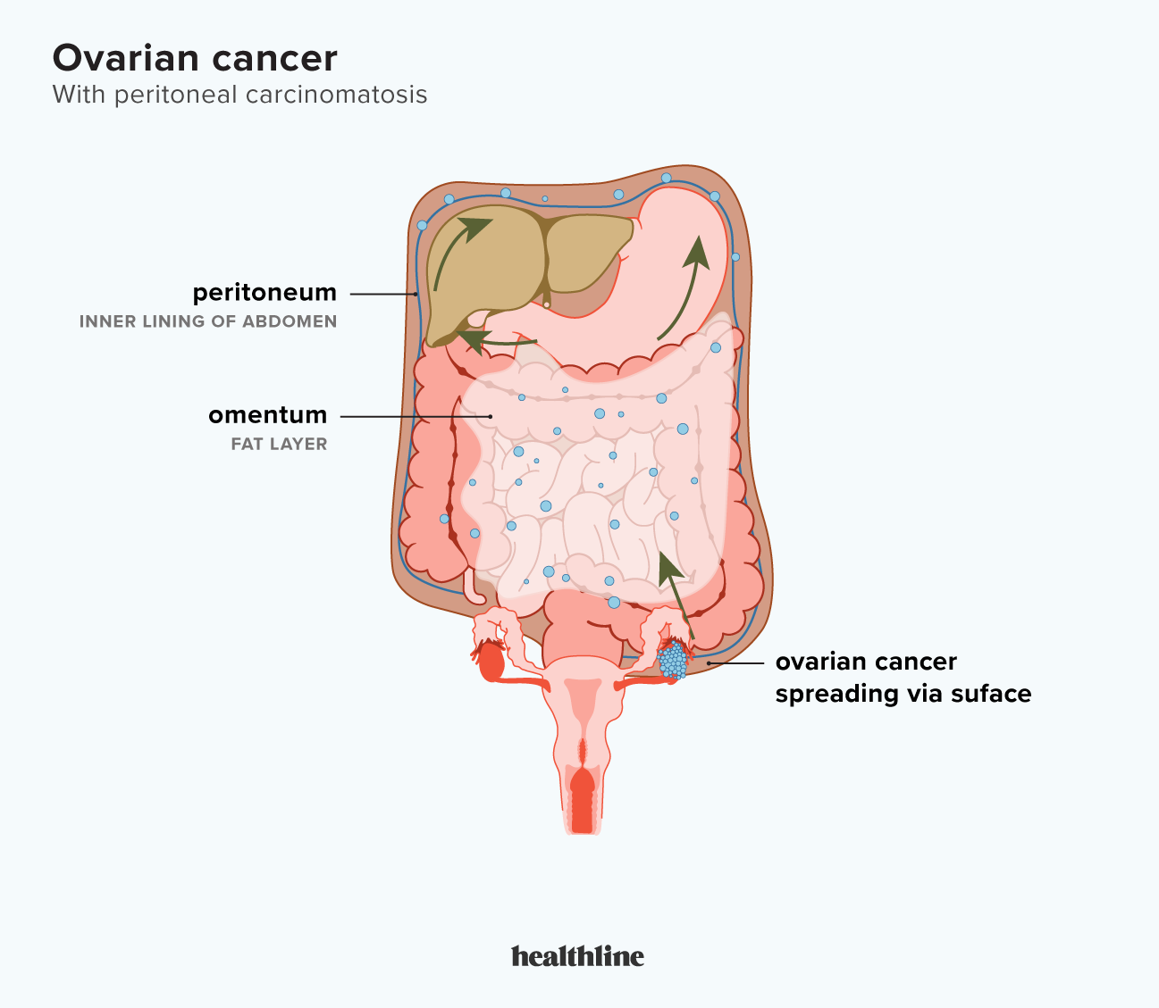 Peritoneal carcinomatosis: What is the link with ovarian cancer?
