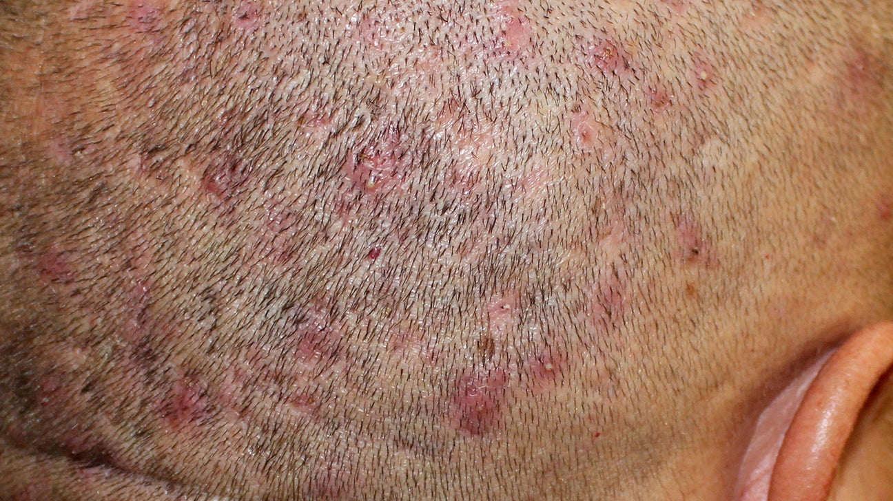 Folliculitis on the left lower breast and submammary area