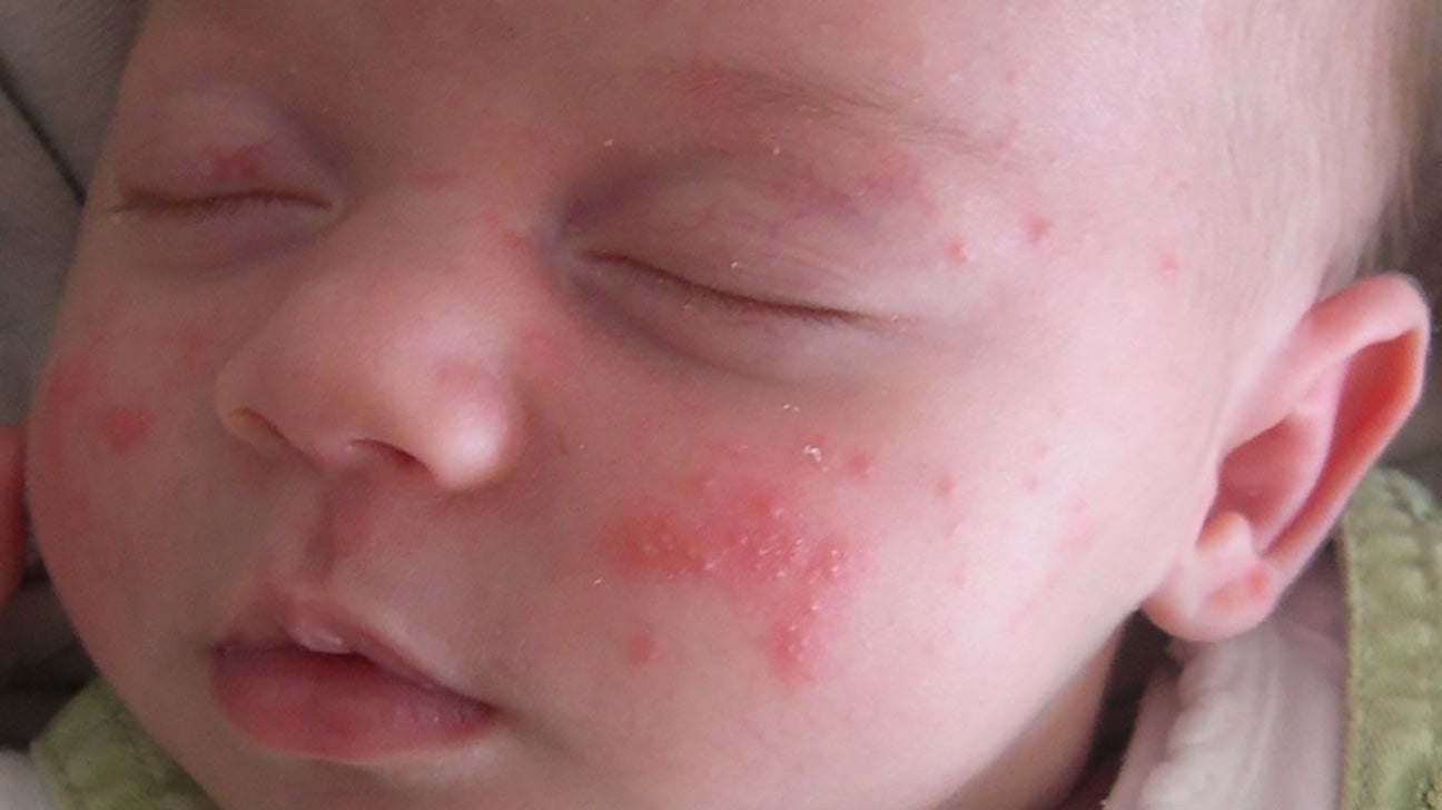 bijnaam verjaardag Calamiteit Baby acne vs. eczema: How to tell the difference