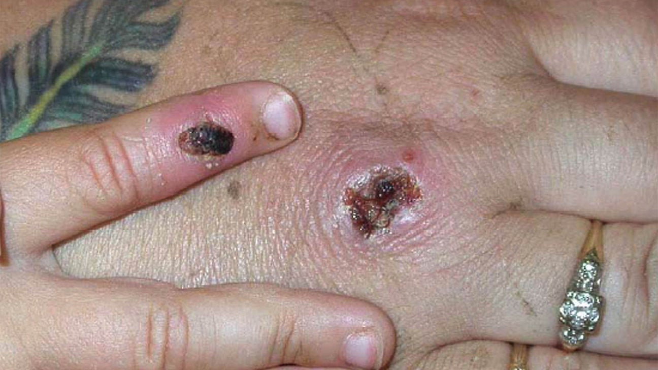 Monkeypox virus: Symptoms, outbreaks, and treatment