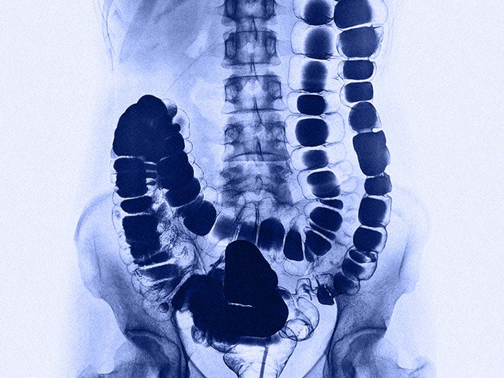 tapeworm in humans xray