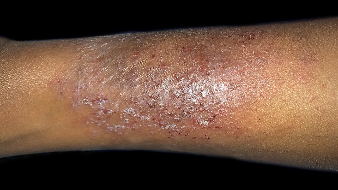 Eczema On Legs Black People