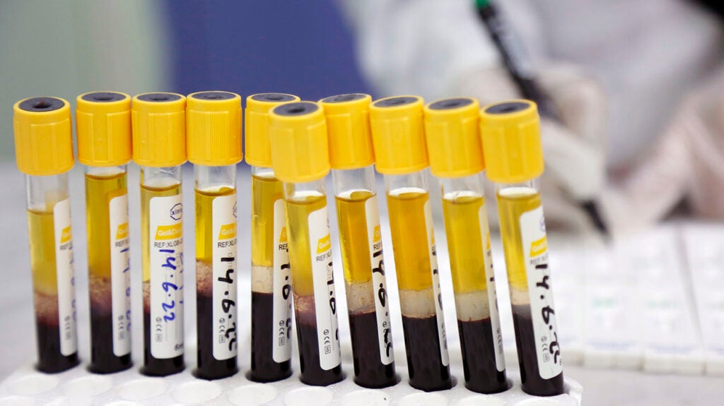 Blood samples to test for high non hdl cholesterol levels