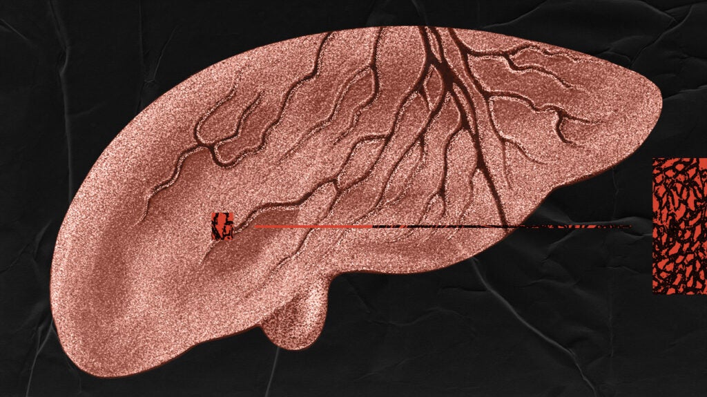 Alpha1 antitrypsin deficiency How does it affect the liver?