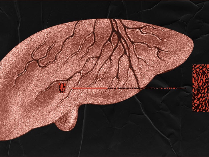 Alpha-1 Antitrypsin Deficiency: How Does It Affect The Liver?