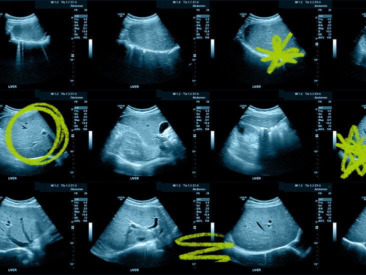 for liver ultrasound: what can mean?