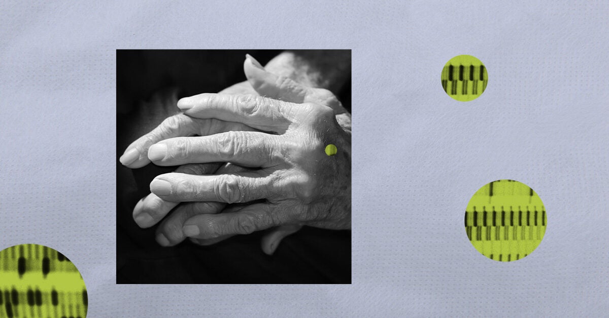 Is psoriatic arthritis Markers, tests, and more