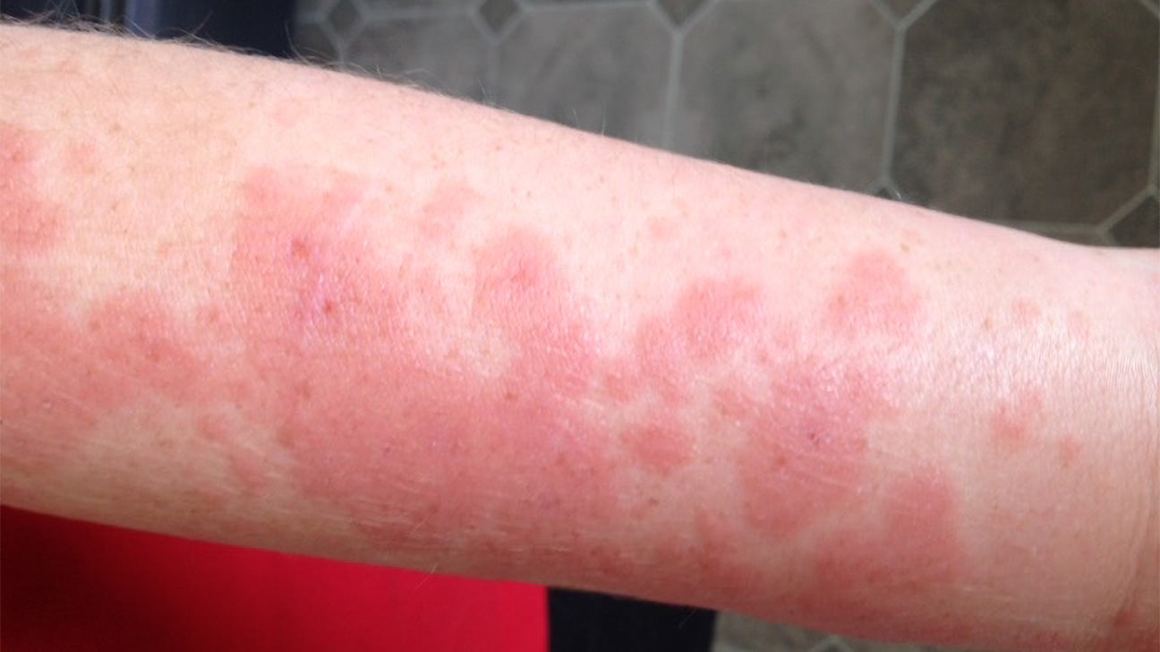 Sun Rash On Arms