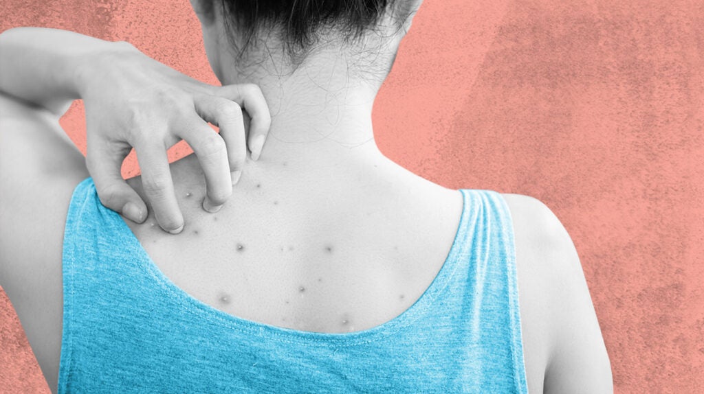 The Complete Guide to Covering Body Acne (And Acne Scars)!
