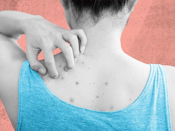 Back acne: How to get rid of it and how to prevent it