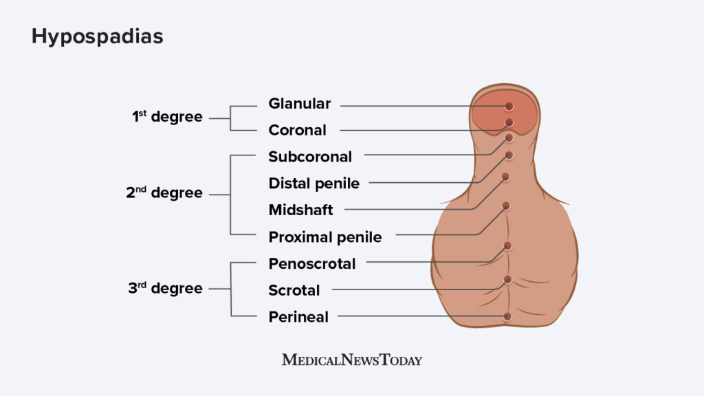 Hypospadias Causes, diagnosis, and treatment