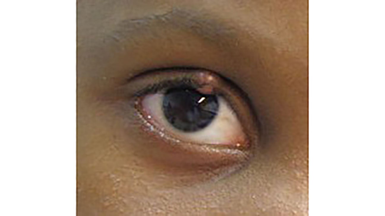 Bump On The Eyelid Types Symptoms Causes Treatment 49 OFF