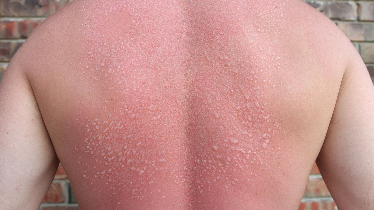  Sunburn Blisters Nose