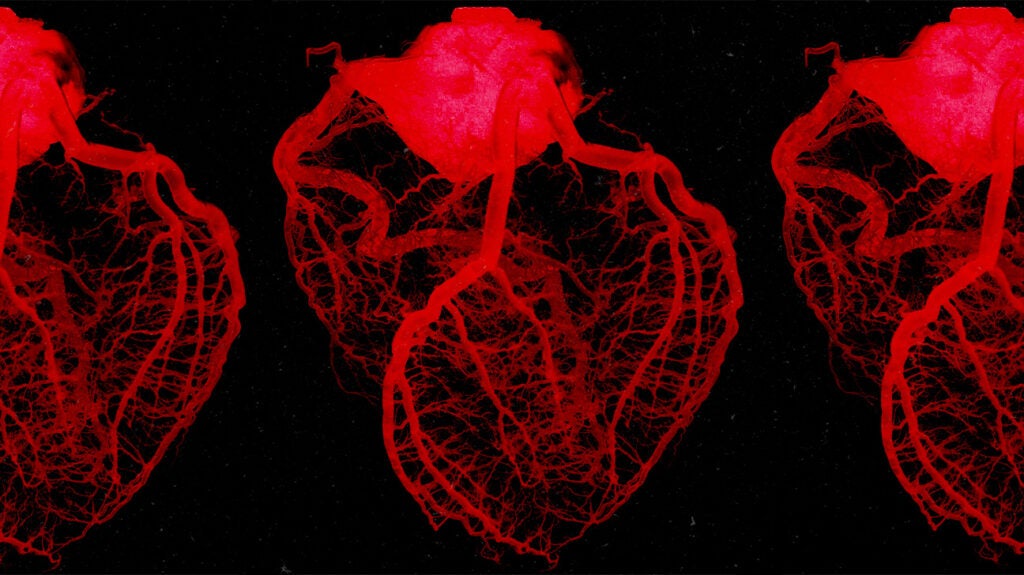 mobitz-type-ii-heart-block-causes-symptoms-and-treatment