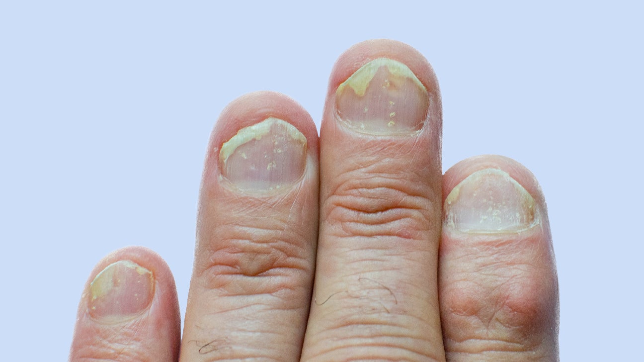 Nail psoriasis: clinical features, pathogenesis, differential diagnose | PTT