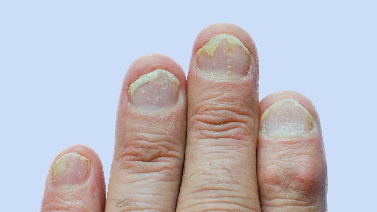 Green Nail Syndrome (GNS, Pseudomonas nail infection, chloronychia, green  striped nails, chromonychia) - Dermatology Advisor