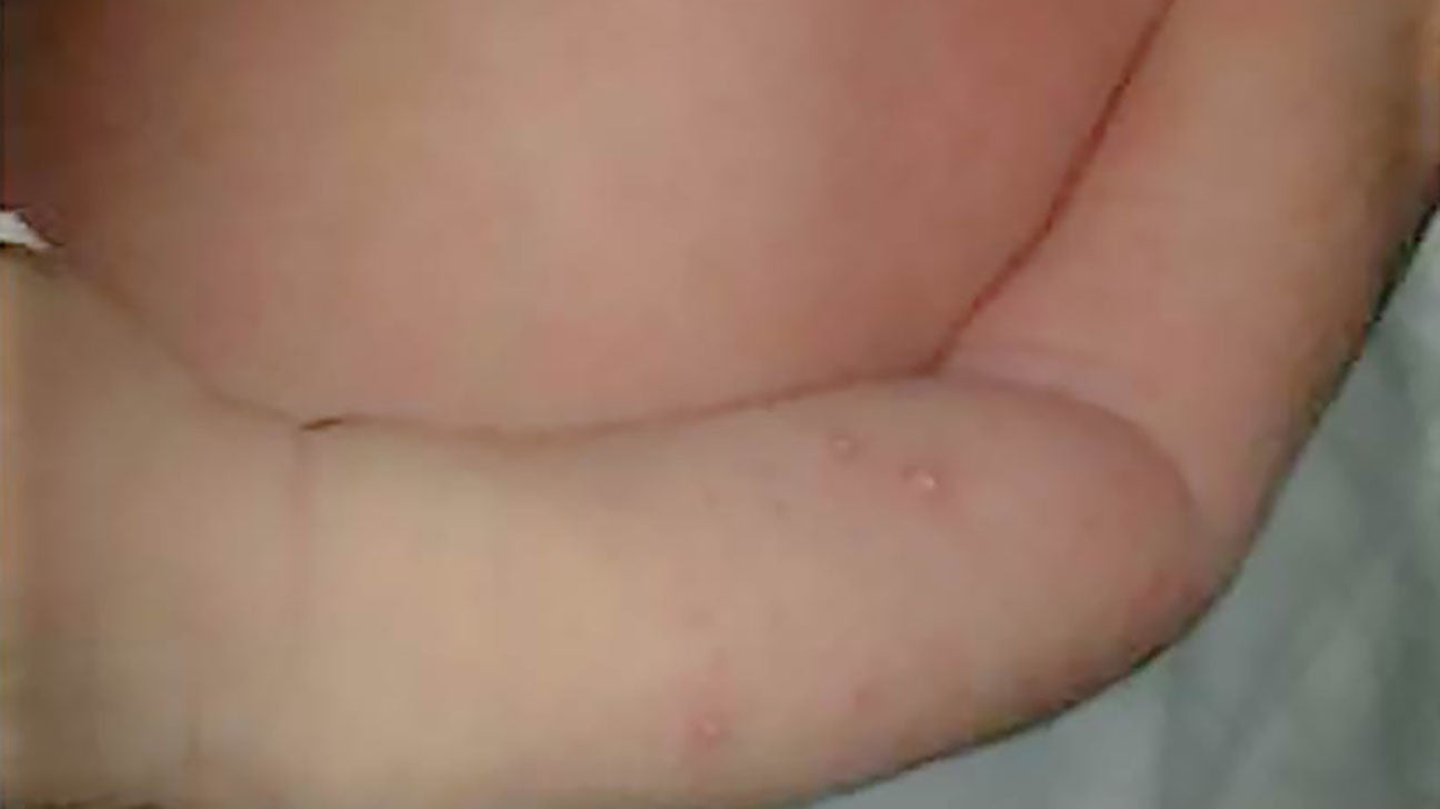 Baby heat rash: Types, pictures, treatment, duration, and more