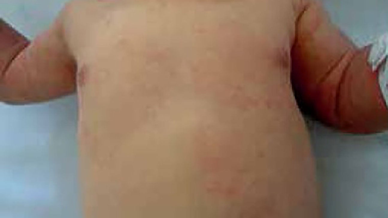 How to get rid of heat rash and prickly heat in children and