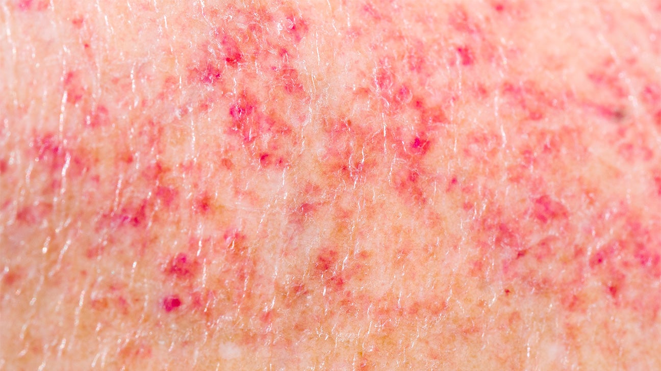 rash: What it is, symptoms, causes, and treatments