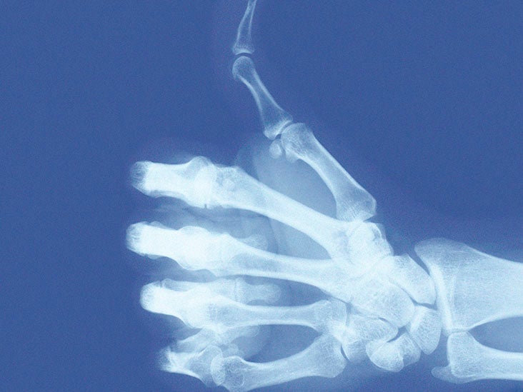 Thumb arthritis surgery Types and what they involve