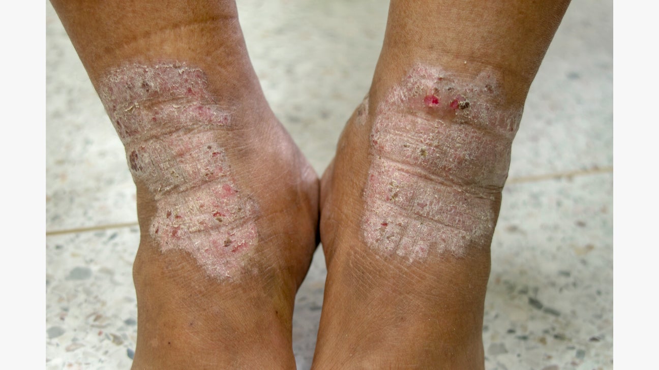 Eczema on feet: Types, symptoms, causes, and more