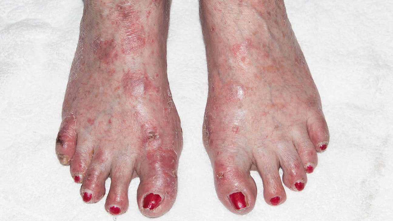 dyshidrotic-eczema-feet