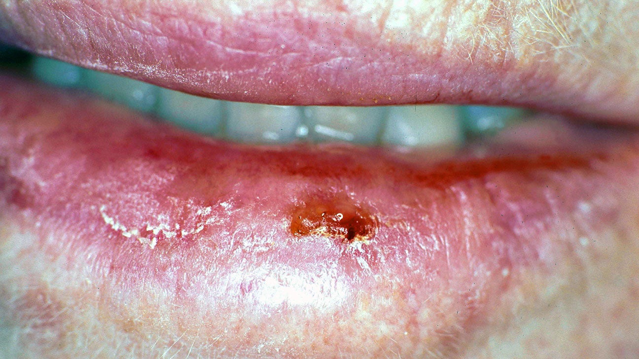 What Are Signs Of Cancer On The Lips